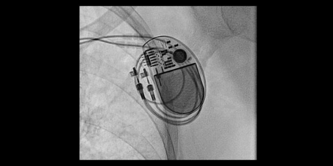 Herzschrittmacher und interner Cardioverter-Defibrillator (ICD